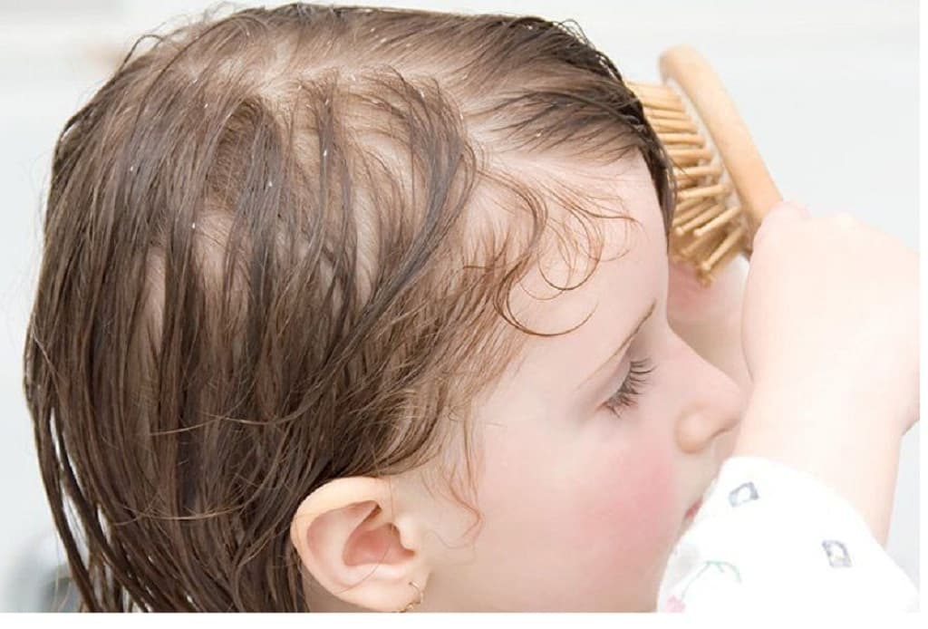 19 Best Dandruff Shampoos for Kids: Reviews & Buying Guide